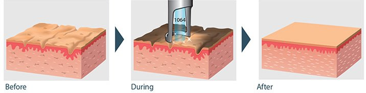 carbon laser peel 